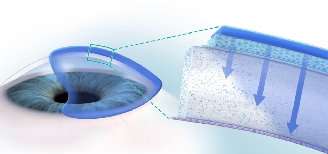 Cystadrops coats the cornea and disolves corneal cystine crystals